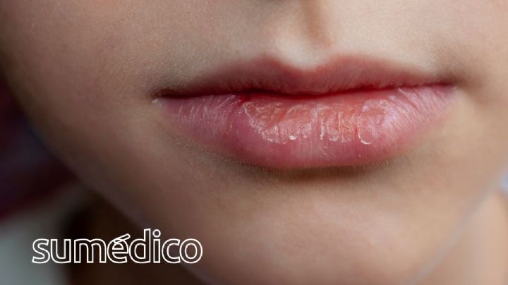 ¿Qué causa que los labios se agrieten? Conoce estas soluciones caseras