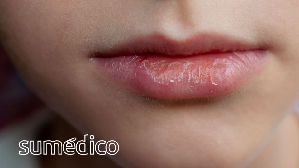 Si tienes labios agrietados, conoce estas soluciones caseras.