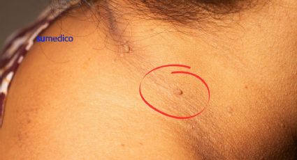 ¿Qué enfermedades se ocultan en las verrugas en el cuello? La UNAM lo explica