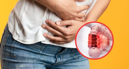 Cáncer de colon ¿se puede prevenir?