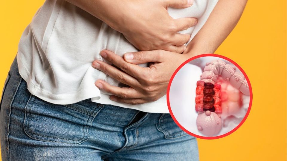 En las primeras etapas, el cáncer de colon no da síntomas.