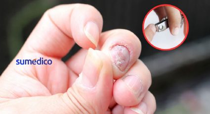 ¿Cómo cortar las uñas cuando tienen hongos?