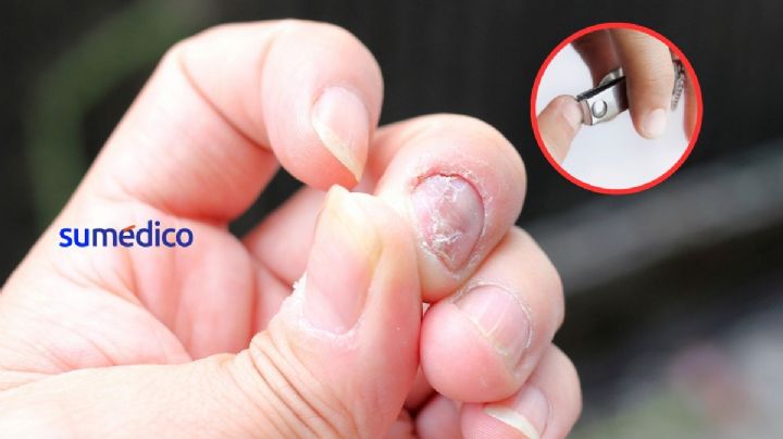 ¿Cómo cortar las uñas cuando tienen hongos?