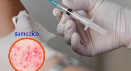 1 de cada 3 adultos padecerá herpes zóster, ¿Cómo prevenir?