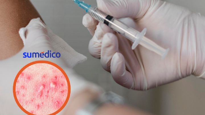 1 de cada 3 adultos padecerá herpes zóster, ¿Cómo prevenir?