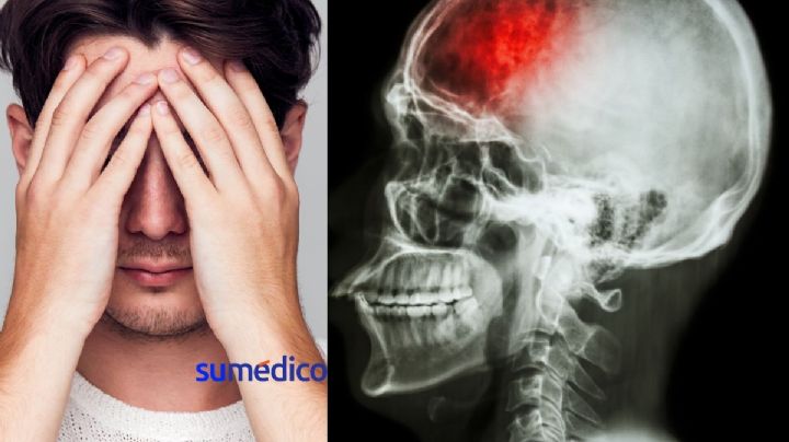 Estos son los factores de riesgo para presentar un derrame cerebral