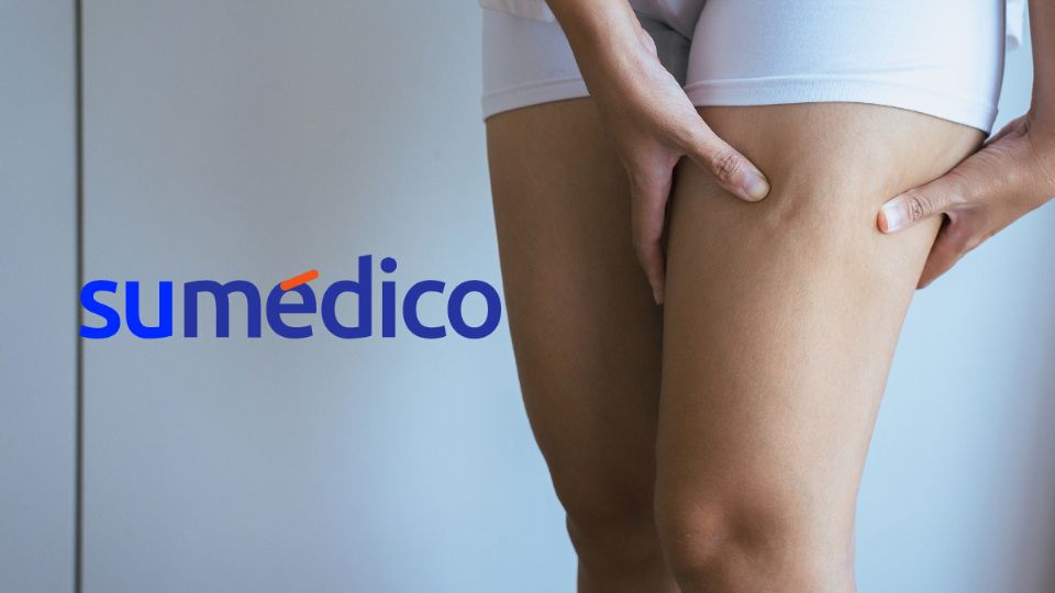 La celulitis es un problema común sobre todo en mujeres.