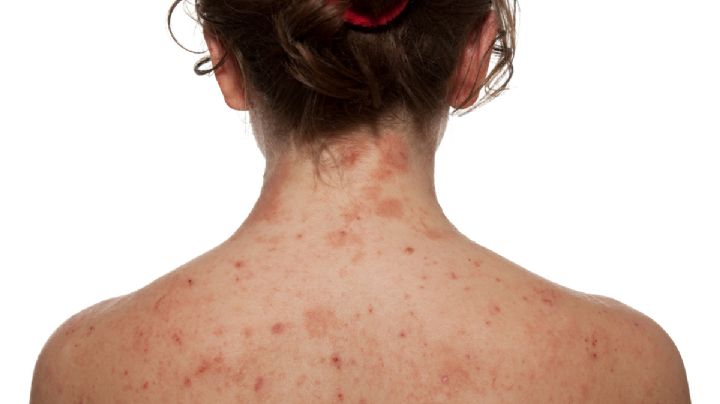 Dermatitis atópica, la enfermedad de la piel más frecuente