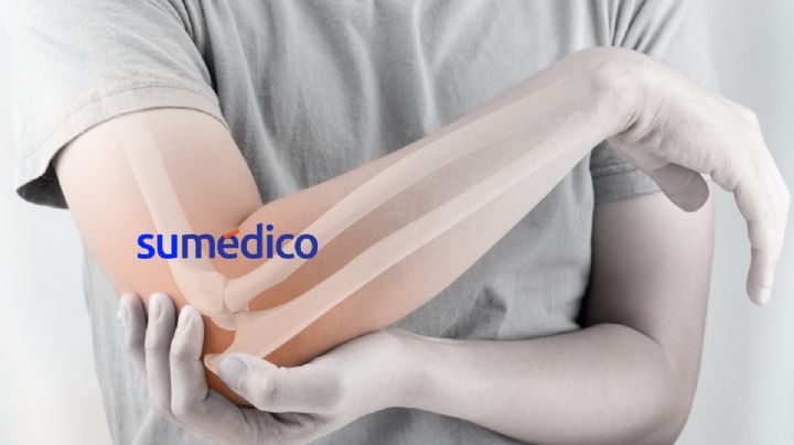 ¿Cómo afecta la osteoporosis a los hombres?