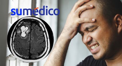 Síntomas que pueden alertar sobre un tumor cerebral