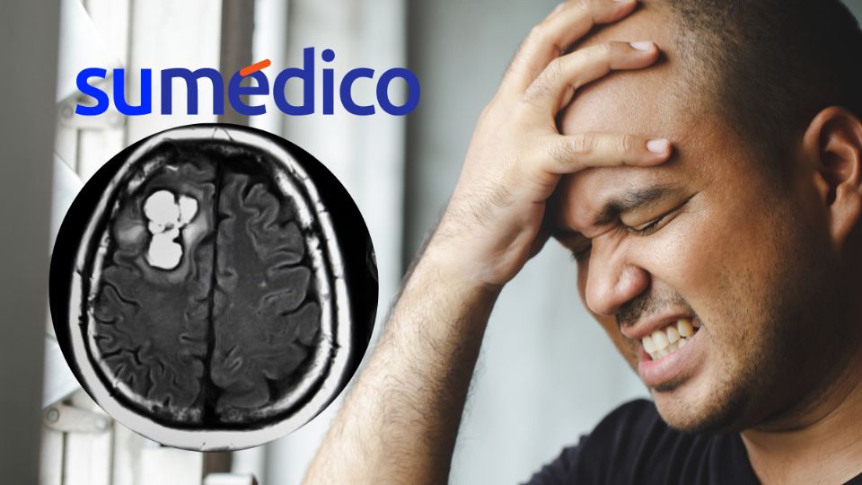 Conoce cuales son las señales de un tumor cerebral