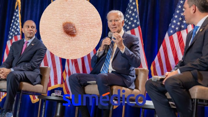 ¿Qué es un carcinoma por el que fue operado Joe Biden?