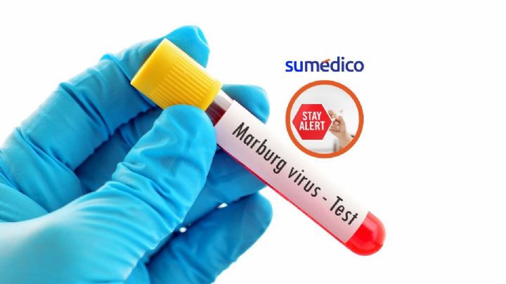 Virus de Marburgo, los CDC emiten alerta ante contagios identificados en África