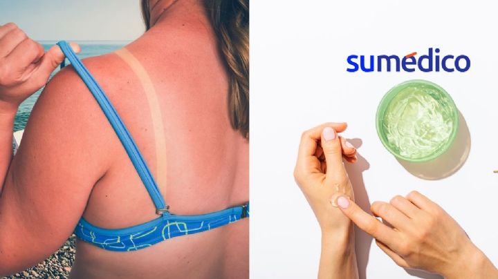¿Te quemaste con el sol? Esto debes hacer para aliviar tu piel