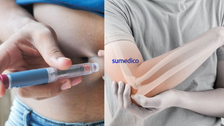 Diabetes puede ocasionar osteoporosis, revela experta