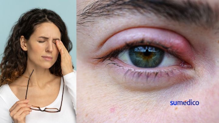 Orzuelo: 5 hábitos que pueden causarlo