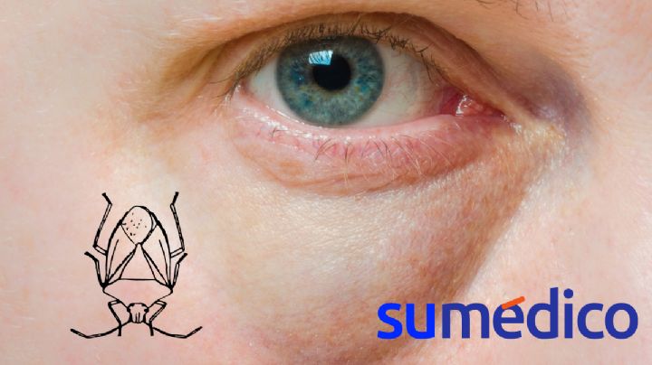 ¿Qué enfermedad transmite la chinche besucona y en qué consiste?