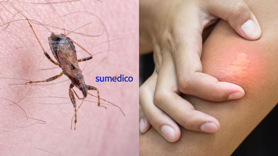 ¿Qué es la vinchuca? ¿Por qué produce la enfermedad de Chagas? Te contamos aquí.