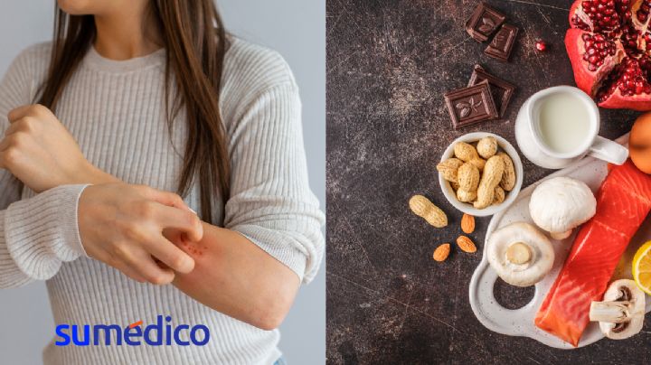 Las alergias alimentarias: una condición a la cual se debe dar atención