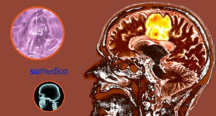 Crean fármaco en gel que detiene el tumor cerebral más agresivo. Te contamos