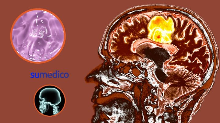 Paciente joven muere luego de que médicos confundieran un tumor cerebral con deshidratación