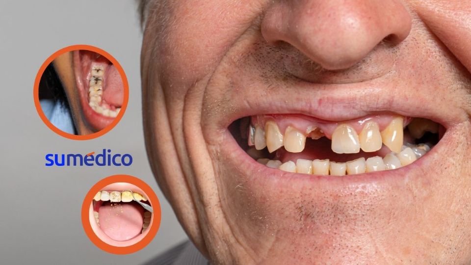 Si te hacen falta piezas dentales, llama a tu dentista antes de tener estos problemas.