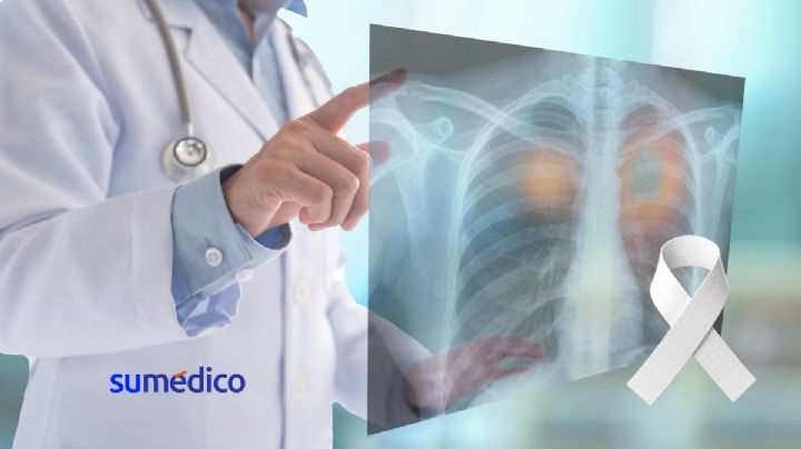 Día Nacional contra el Cáncer de Pulmón en México: retos y avances médicos