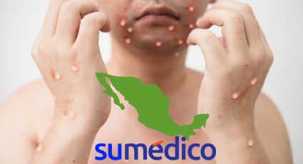 ¿Qué es la mpox, enfermedad que está presente en México?