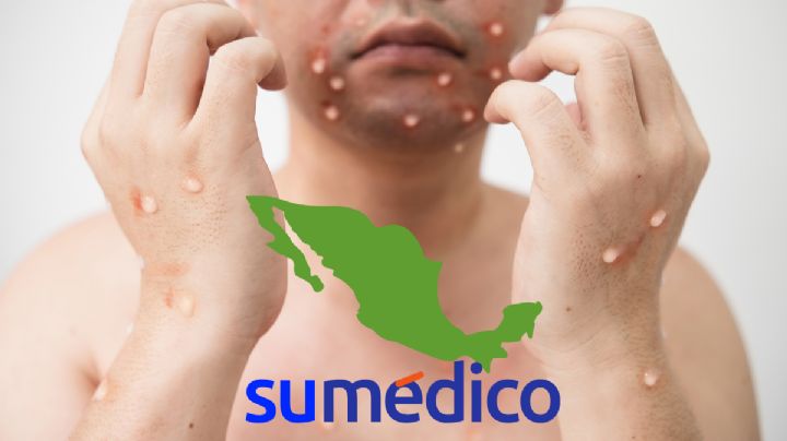¿Qué es la mpox, enfermedad que está presente en México?