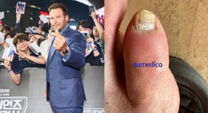 ¿Hongos en las uñas como Chris Pratt? Puedes eliminarlos con bicarbonato