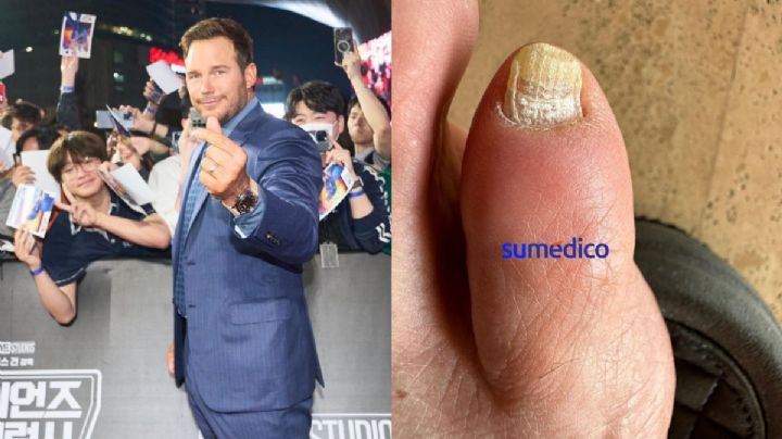 ¿Hongos en las uñas como Chris Pratt? Puedes eliminarlos con bicarbonato
