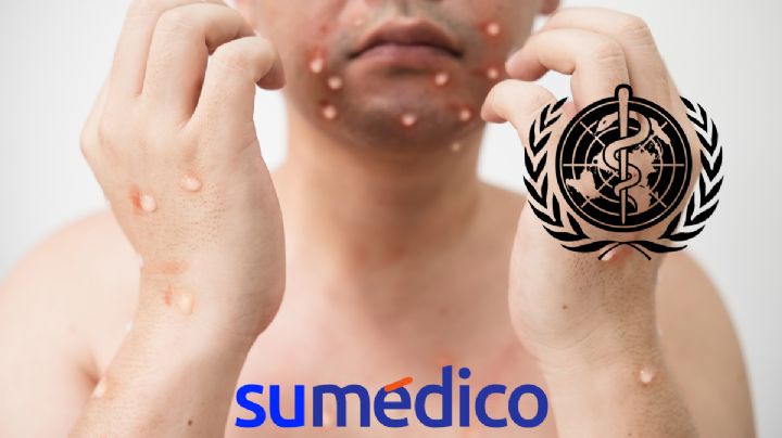 OMS levanta la emergencia internacional contra la viruela del mono ¿Qué significa?
