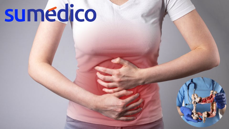 Hay nuevos cuatro síntomas que alertan sobre el cáncer de colon.