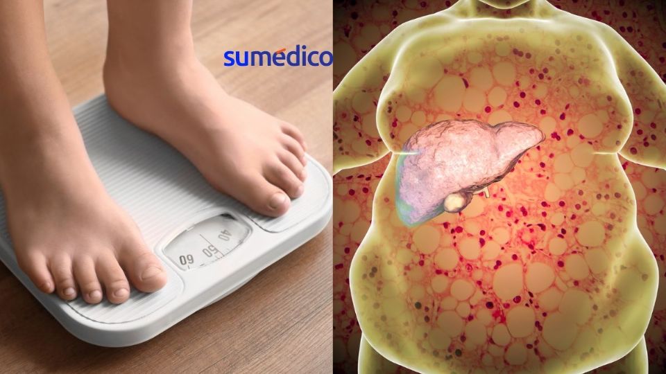 El hígado graso se ha establecido como la causa más común de enfermedad hepática crónica a nivel mundial.