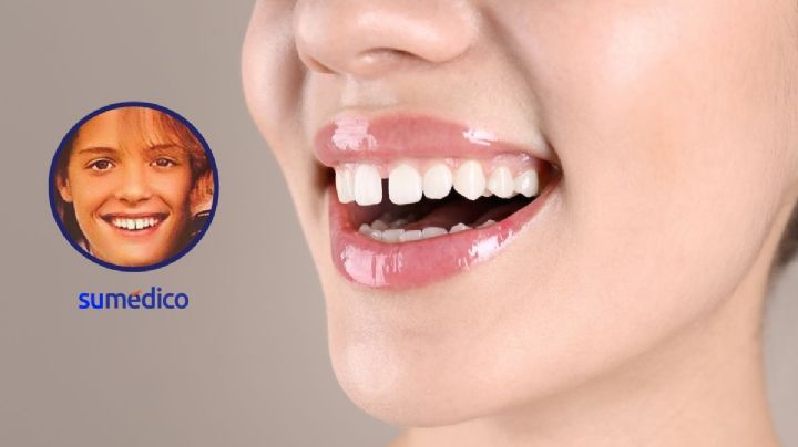 ¿Qué es la diastema, rasgo físico que tenía Luis Miguel de joven?