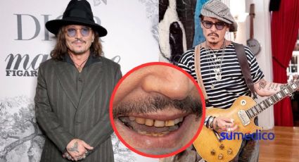 ¿Qué causa el aspecto de dientes “podridos” como los de Johnny Deep?