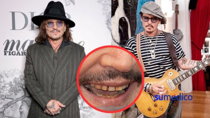 ¿Qué causa el aspecto de dientes “podridos” como los de Johnny Deep?