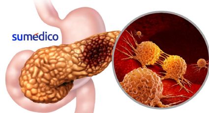 Así actúa la proteína que produce cáncer de páncreas