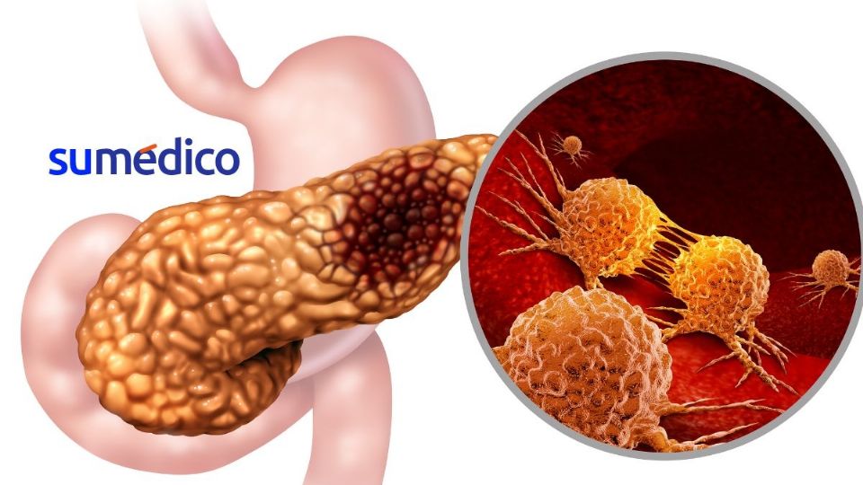 La proteína SRSF1 podría estar relacionada con el cáncer de páncreas, especialmente el adenocarcinoma pancreático ductal (PDAC, por sus siglas en inglés).