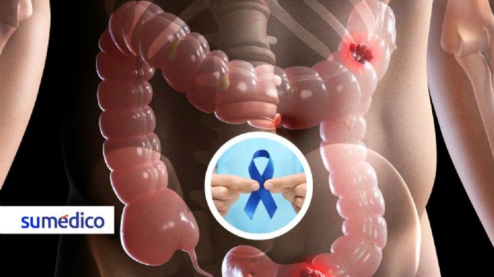 Crean nuevo tratamiento para cáncer urotelial, cáncer de vejiga común