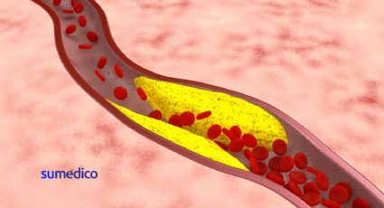 El desarrollo de la aterosclerosis como una enfermedad sistémica