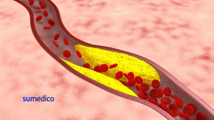 El desarrollo de la aterosclerosis como una enfermedad sistémica