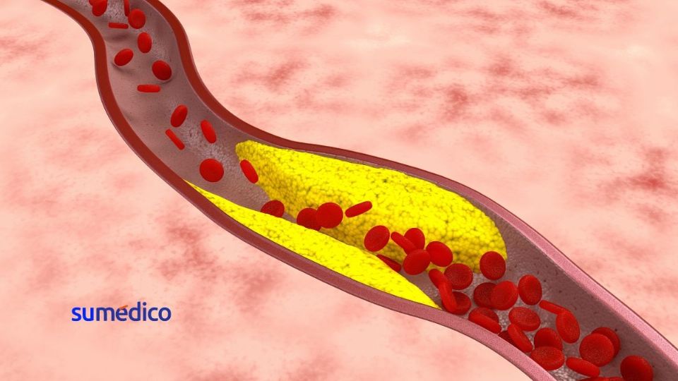 Existen más de 300 regiones asociadas al proceso de aterosclerosis y riesgo cardiovascular.