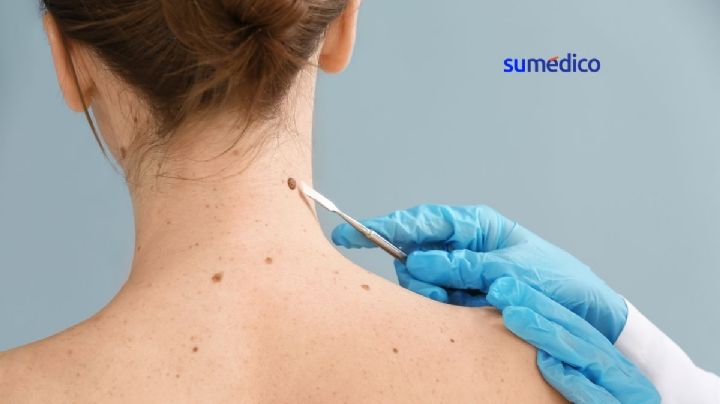 ¿Tienes manchas o lunares? Realizarán jornada gratuita para detectar cáncer de piel