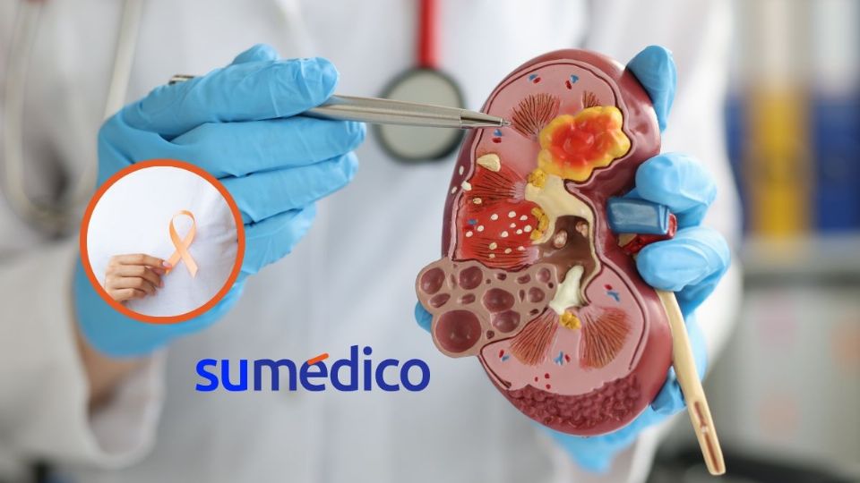 Fundación Más Que Ideas comparte información sobre cáncer y salud renal de la mano de especialistas y paciente trasplantada.