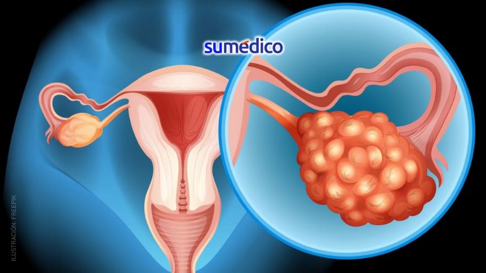 El cáncer de ovario es de los más letales por su diagnóstico tardío.