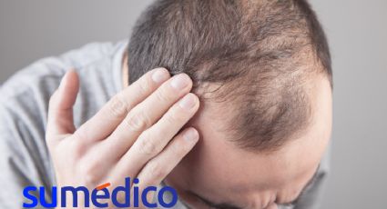 ¿Qué es el minoxidil y por qué se ha disparado su venta en Estados Unidos?