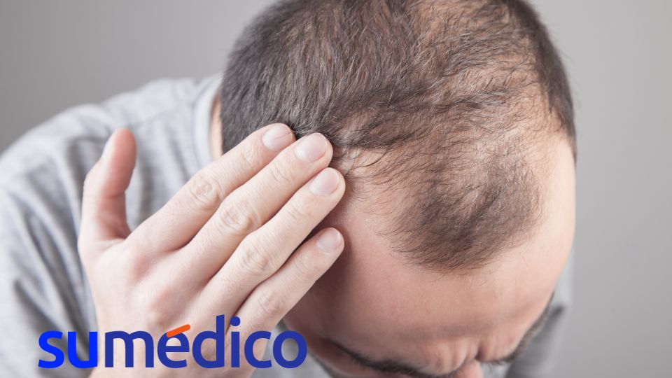 El minoxidil puede ayudar al crecimiento del cabello.