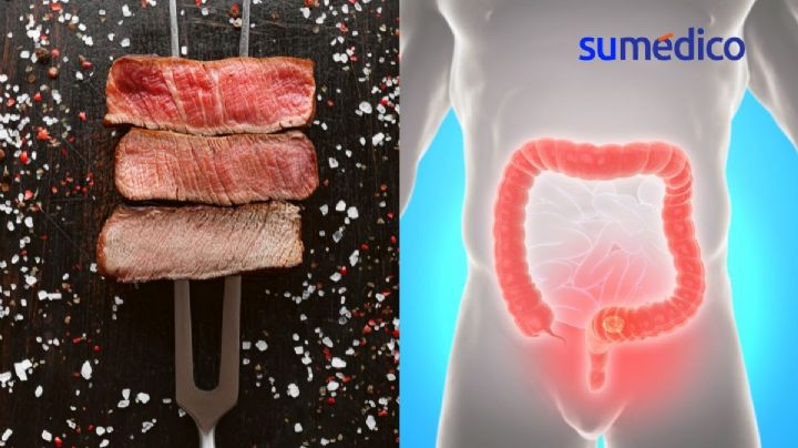 Azúcares y carne roja: factores de riesgo para cáncer en adultos jóvenes
