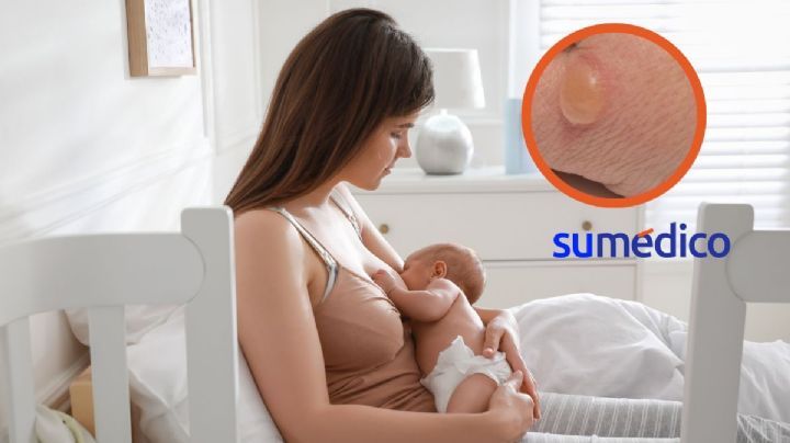 ¿Ampollas ocasionadas por la lactancia? Aplica estos consejos para evitarlas y tratarlas